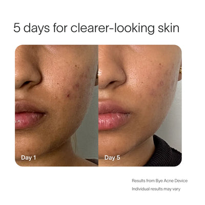 Bye Acne Pro Kit